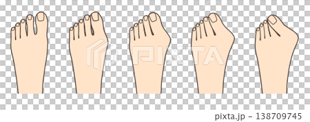 圖示比較了拇趾外翻的症狀發展過程。 138709745