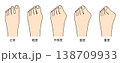 外反母趾の進行具合を比較した症状別イラスト（軽症・中等度・重症） 138709933