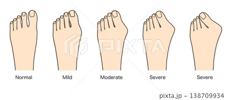 外反母趾の進行具合を比較した症状別イラスト（軽症・中等度・重症） 138709934