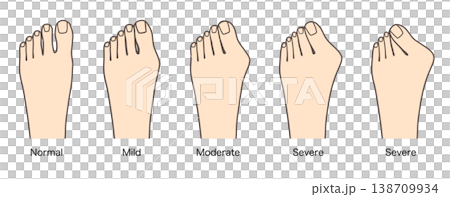 外反母趾の進行具合を比較した症状別イラスト（軽症・中等度・重症） 138709934