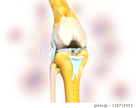 knee joint arthritis knee joint arthritis 138710353