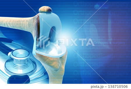 Knee joint replacement. medical background concept Knee joint replacement. medical background concept 138710506