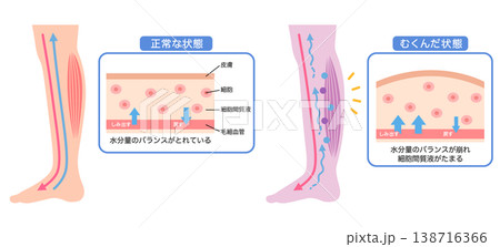 むくみの構造 水分量のバランス 断面図 むくみの構造 水分量のバランス 断面図 138716366