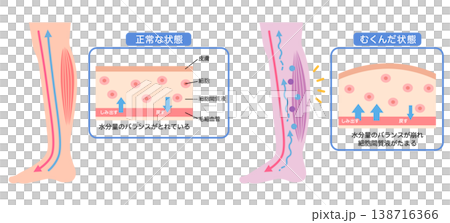 むくみの構造 水分量のバランス 断面図 むくみの構造 水分量のバランス 断面図 138716366