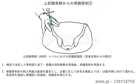 上前腸骨棘 (ASIS)からの骨髄穿刺刺入角度についてのイラストです。 上前腸骨棘 (ASIS)からの骨髄穿刺刺入角度についてのイラストです。 138718758