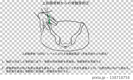 上前腸骨棘 (ASIS)からの骨髄穿刺刺入角度についてのイラストです。 上前腸骨棘 (ASIS)からの骨髄穿刺刺入角度についてのイラストです。 138718758