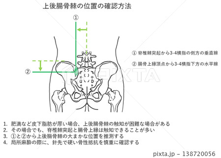 上後腸骨棘の位置の確認方法 138720056