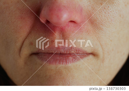Close-Up of Irritated Skin and Chapped Lips from Cold 138730303