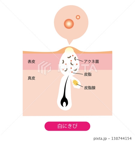 白ニキビ 白ニキビ 138744154