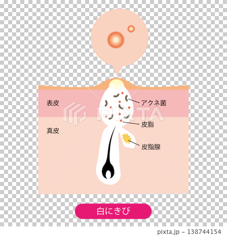 白ニキビ 白ニキビ 138744154
