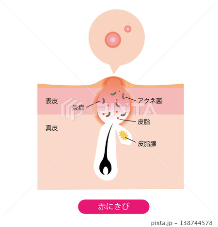 赤ニキビ 138744578