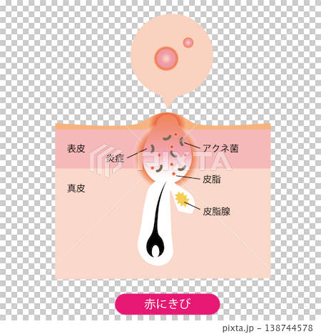 赤ニキビ 138744578
