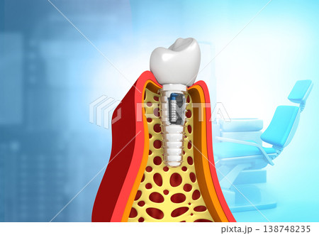 Dental implant concept 138748235