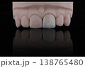 Mirror copy of central maxillary incisor, ultra thin dental ceramic veneer or crown on printed model 138765480