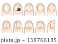 ゆるめシンプルな異常状態の爪セット　アナログ風 138766185