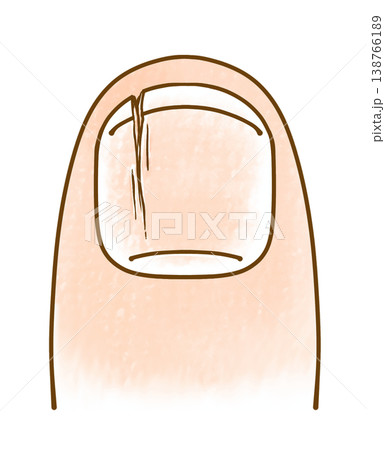 ゆるめシンプルな割れた爪　アナログ風 138766189