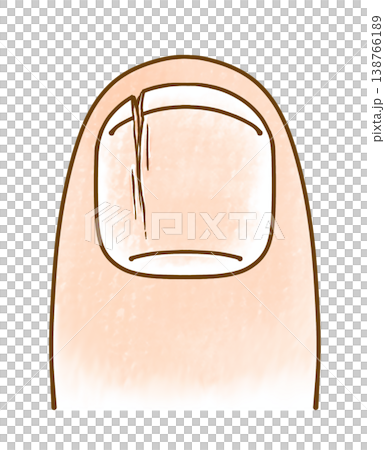 ゆるめシンプルな割れた爪　アナログ風 138766189