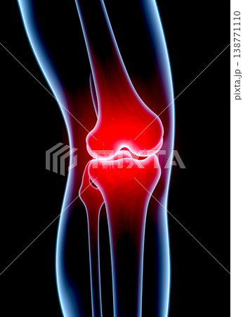 Close up medical graphic illustration of human knee joint bones in x-ray style with intense red glow to visualize severe pain and inflammation. 138771110