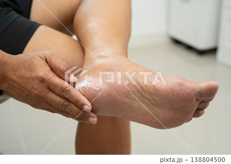 Asian woman check feet with crack and dry heel skin, Diabetic Foot. 138804500