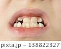 Child with crowded teeth. Crooked permanent and baby teeth in a 8 year old child mouth. 138822327