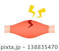 肉離れ（部分断裂） 138835470