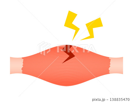 肉離れ（部分断裂） 138835470