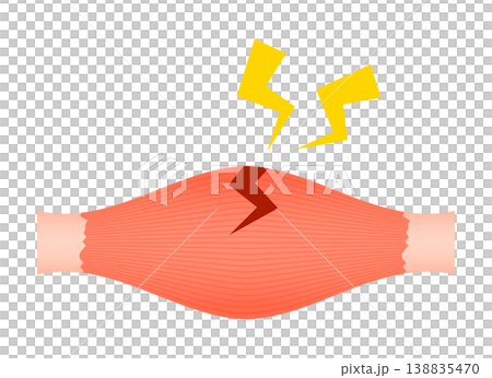 肉離れ（部分断裂） 138835470
