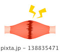 肉離れ（完全断裂） 138835471