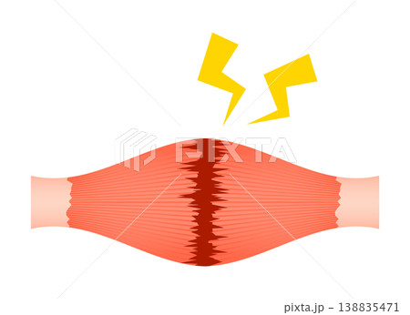 肉離れ（完全断裂） 138835471
