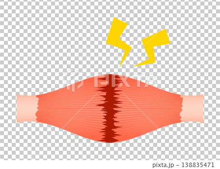 肉離れ（完全断裂） 138835471