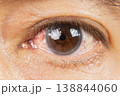 Blunt Eye Trauma , An eye impact injury causing potential damage to the eyeball. 138844060