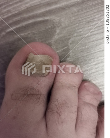 mold on the nail mold on the nail 138851802