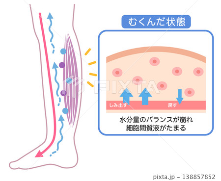 むくみの構造　水分量のバランス　断面図 138857852
