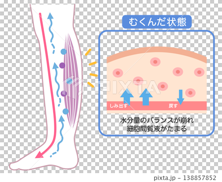 むくみの構造　水分量のバランス　断面図 138857852