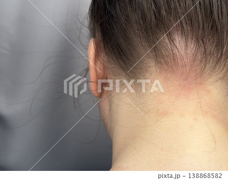 atopic dermatitis in an adult young girl has red scaly spots on the back of the neck close-up 138868582