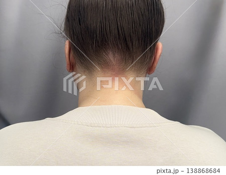 atopic dermatitis in an adult young girl has red scaly spots on the back of the neck close-up atopic dermatitis in an adult young girl has red scaly spots on the back of the neck close-up 138868684