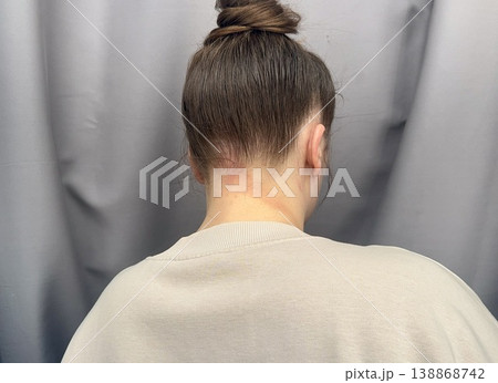 atopic dermatitis in an adult young girl has red scaly spots on the back of the neck close-up 138868742