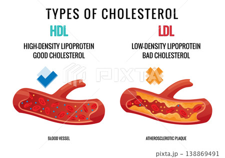 Types of cholesterol in human blood vessels. Normal and narrowed artery for explanation diseases. High-Density Lipoprotein HDL and Low-Density Lipoprotein LDL. Vector illustration Types of cholesterol in human blood vessels. Normal and narrowed artery for explanation diseases. High-Density Lipoprotein HDL and Low-Density Lipoprotein LDL. Vector illustration 138869491