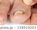 Ingrown toenail on a senior feet with white backgroundClose-up ingrown toenail on senior feet with white background. 138919203