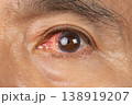 Blunt Eye Trauma , An eye impact injury causing potential damage to the eyeball. 138919207