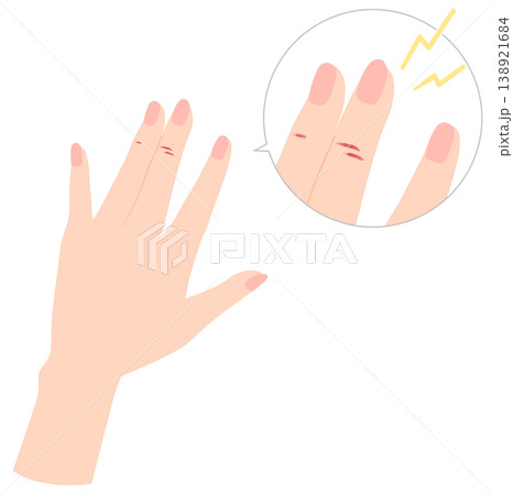 傷んだ手のイラスト　あかぎれ、ひび割れ 138921684
