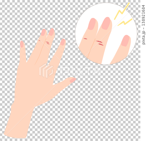 傷んだ手のイラスト　あかぎれ、ひび割れ 138921684