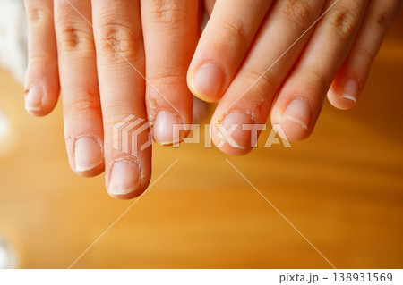 子どもの手のささくれや乾燥した指先のトラブルイメージ 138931569