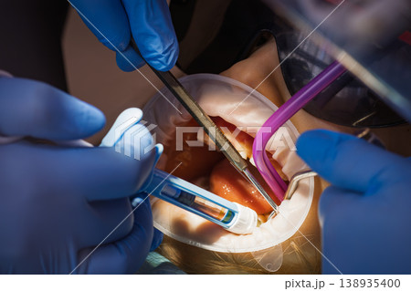 Dentist applying filling material to child tooth Dentist applying filling material to child tooth 138935400
