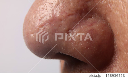 Blackheads acne. Macro close up image of facial skin and nose. showing visible pores blackheads acne marks and skin texture. Ideal for skincare dermatology cosmetic treatment and skin health concept Blackheads acne. Macro close up image of facial skin and nose. showing visible pores blackheads acne marks and skin texture. Ideal for skincare dermatology cosmetic treatment and skin health concept 138936328