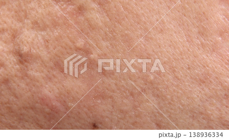 Blackheads acne. Macro close up image of facial skin and nose. showing visible pores blackheads acne marks and skin texture. Ideal for skincare dermatology cosmetic treatment and skin health concept Blackheads acne. Macro close up image of facial skin and nose. showing visible pores blackheads acne marks and skin texture. Ideal for skincare dermatology cosmetic treatment and skin health concept 138936334