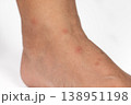 Close up view of flea bites on lower legs and feet skin. 138951198