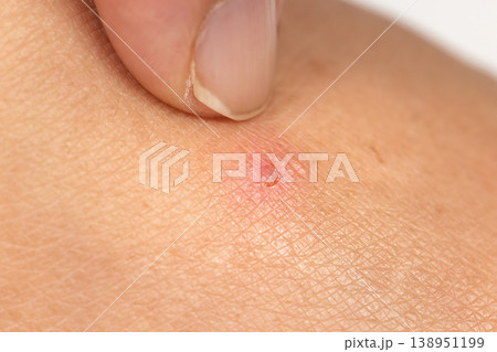Close up view of flea bites on lower legs and feet skin. 138951199