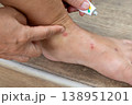 Close up view of flea bites on lower legs and feet skin. 138951201
