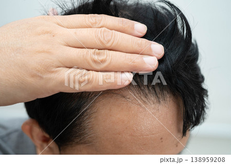 Bald in the middle head and begin no loss hair glabrous of mature man. Bald in the middle head and begin no loss hair glabrous of mature man. 138959208
